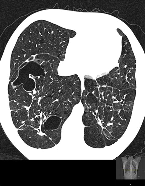 Figure 1 From Diffuse Cystic Lung Disease Semantic Scholar