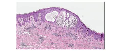 Low Power Field Â400 Of Hematoxylin And Eosin Hande Stain Of The