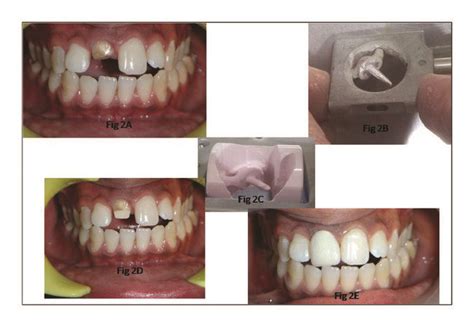 Fractured Central Incisor Restored With Copy Milled All Ceramic Post