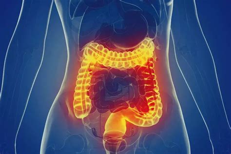 Ulcerative Colitis An Update On Management Medicine Today