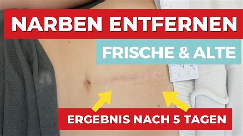 Narben Entfernen Frische Alte Narben Das Ergebnis Nach 5 Tagen