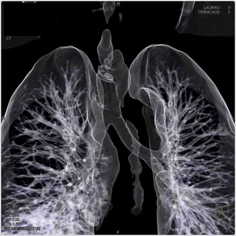 Stent In Trachea In 3d With Tracheal Stenosis Chest Case Studies