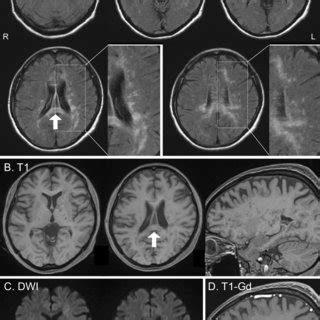 Figure Brain Mri Findings At The Initial Visit A Flair Images B