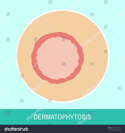 Closeup Skin Fungal Infection Vector Illustration Stock Vector (Royalty