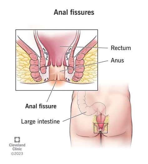 Anal Fissure Or Hemorrhoid