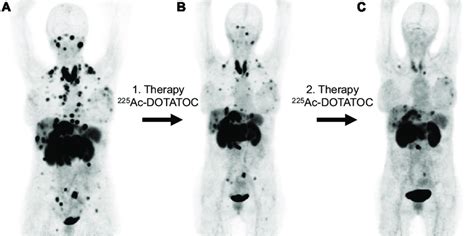 68 Ga DOTATOC PET CT Images Of A Patient With A Multi Resistant