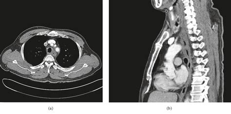 Pdf A Case Of Thermal Esophageal Injury Induced By Sodium Picosulfate