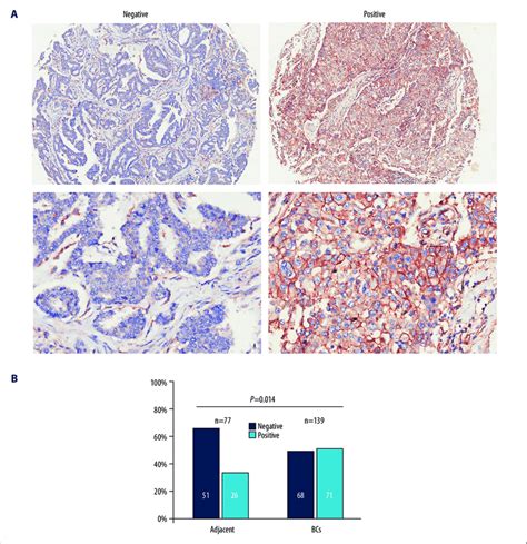 Cd81 Expression Was Upregulated In Breast Cancer Tissues In Tissue