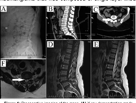 Figure From Pure Lumbar Epidural Cavernous Hemangioma With