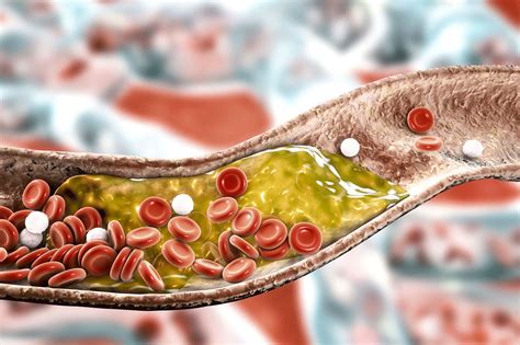 What Is Arteriosclerosis Atherosclerosis Yourcareeverywhere