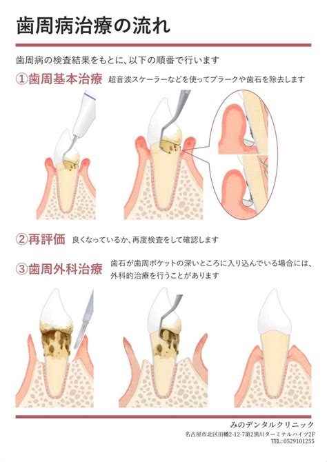 歯周病治療の流れ 黒川駅名古屋市北区1分の歯医者｜みのデンタルクリニック
