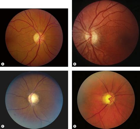 Optic Atrophy Ento Key