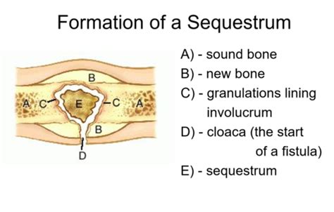 Med Surg Week 9 Alterations In The Musculoskeletal System Flashcards