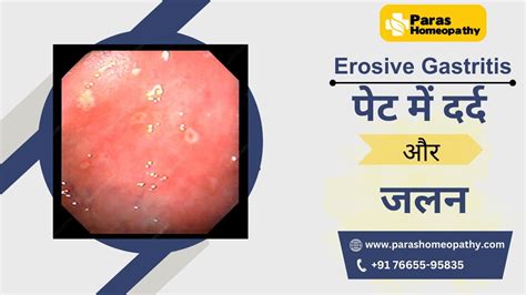 Erosive Gastritis Erosive Gastritis