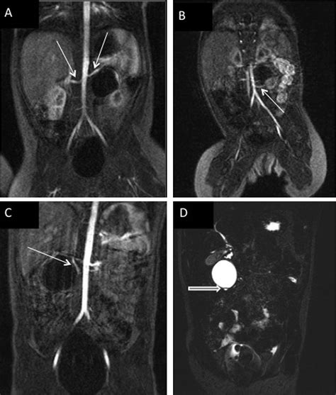 Detection Of Crossing Vessels In Pediatric Ureteropelvic Junction