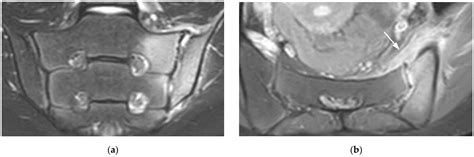 Si Joint Inflammation Mri - mapasebab