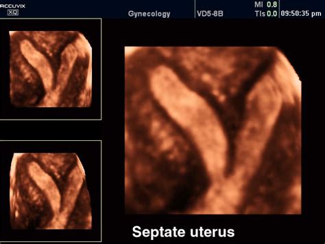 Medison Ru Septate Uterus Cine D Accuvix Xq