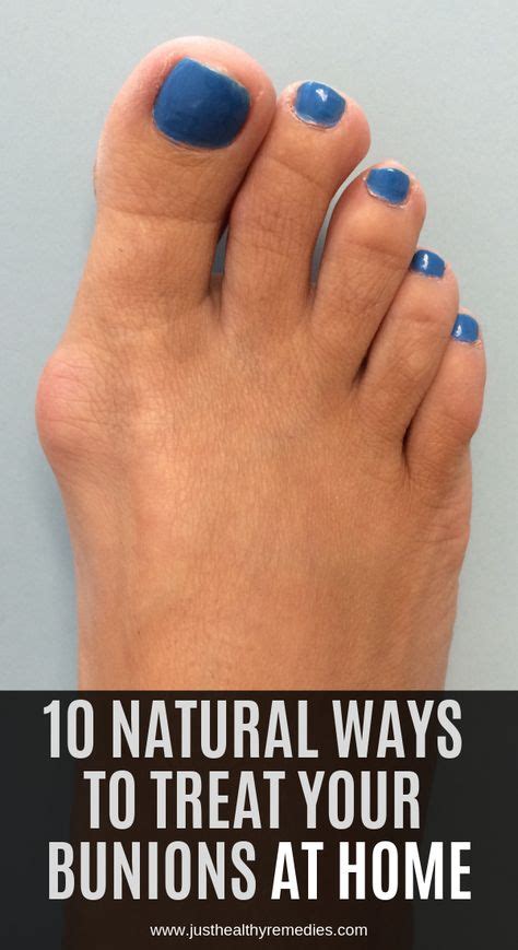 10 Natural Ways To Treat Your Bunions At Home Natural Remedies