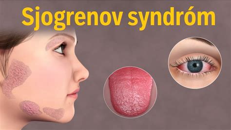 Sjogrenov Syndr M Pr Znaky Diagnostika Lie Ba