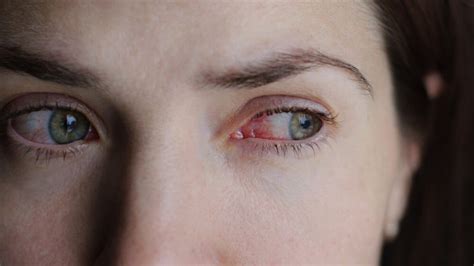 Allergic Conjunctivitis: Causes, Symptoms, and Treatment | Allergy ...