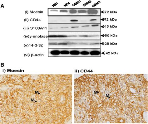 Verification Of Moesin And Cd44 Overexpression In Gbms A Western