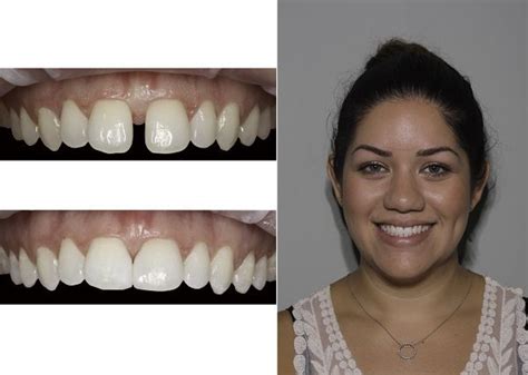 Closing A Diastema With Bioclear Matrices The Dental Warrior A