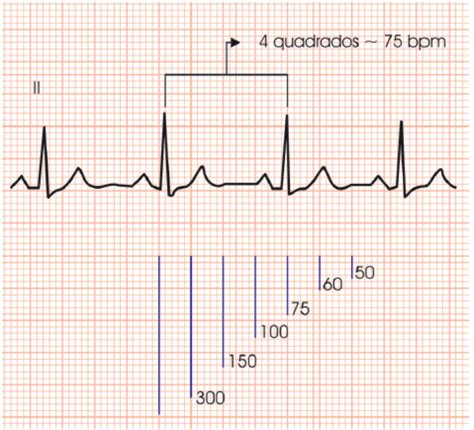 Como Ler Um Eletrocardiograma Em 10 Passos