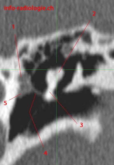 Ct Scan Of The Middle Ear
