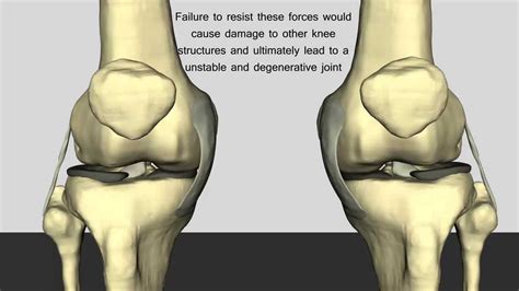 Posterior Cruciate Ligament Origin And Insertion