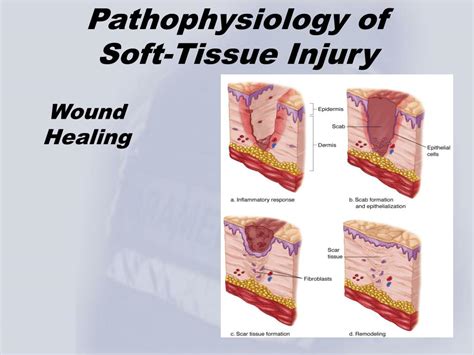 Ppt Chapter 5 Soft Tissue Trauma Powerpoint Presentation Free