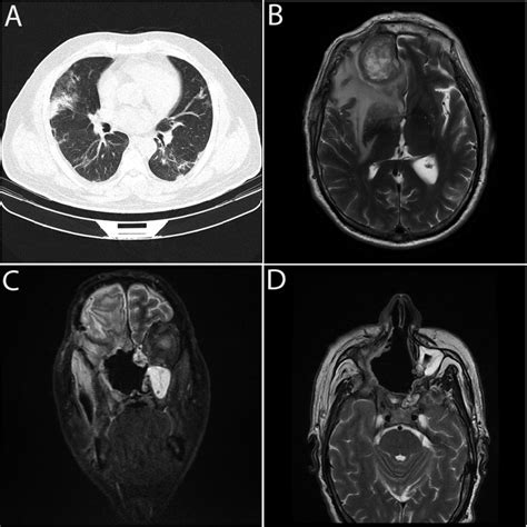 Chest Ct Scan Parenchymal Window Showing Bilateral Patchy Download Scientific Diagram