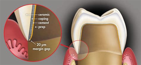 Choosing Between Zirconia Crowns And Pfm Crowns Glidewell