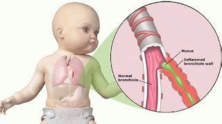 Bronquiolite Saiba Tudo Sobre A Doen A Que Acomete Beb S No Inverno