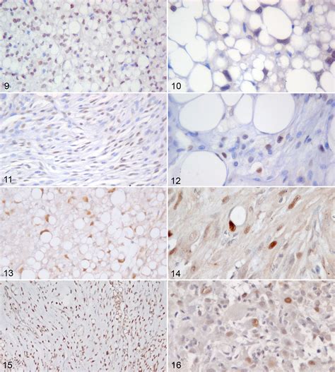 Histological Classification And Immunohistochemical Evaluation Of Mdm