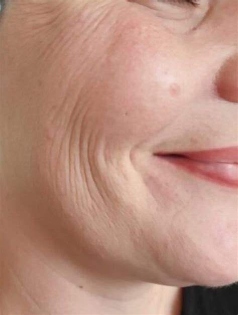 10 Best Ways To Lessen Deep Wrinkles Around Mouth Artofit