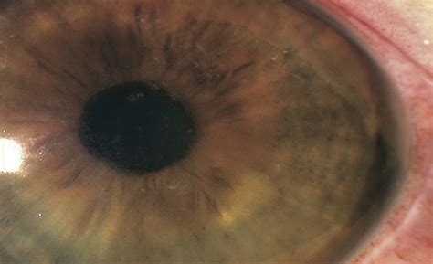 Diffuse Lamellar Keratitis And Corneal Edema Associated With Journal Of Cataract