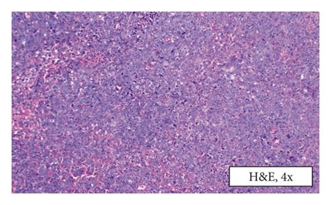 Incisional Biopsy Photomicrograph Of Incisional Biopsy Tissue Showing