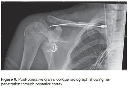 outcomes  treatment  displaced midshaft clavicle fractures