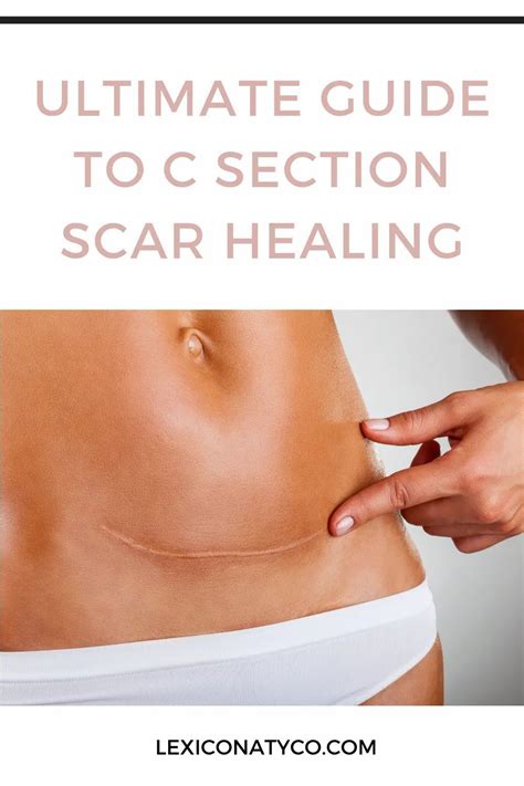 C Section Scar Recovery Artofit