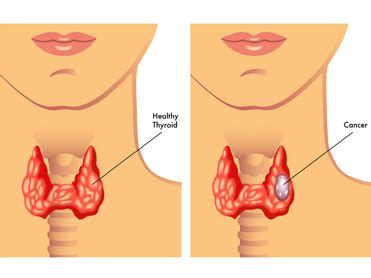 Patologia Y Tratamiento Otros Problemas Patologia Glandula Tiroides Y