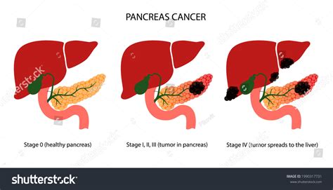 Pancreatic Cancer Stages Pancreas Disease Medical Stock Vector (Royalty ...