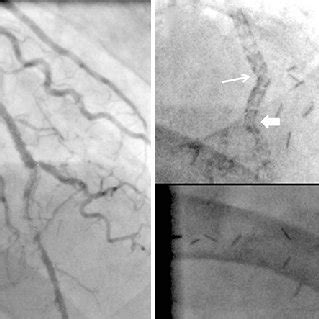 A Final Angiography After Third Drug Eluting Stents Terumo Nobori