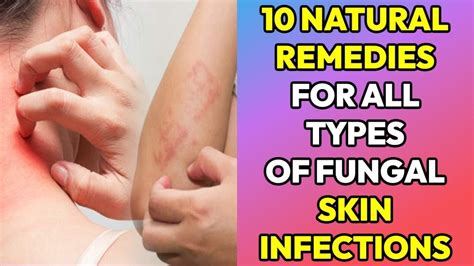 10 Natural Remedies For Fungal Infection On Skin Tinea Ringworm