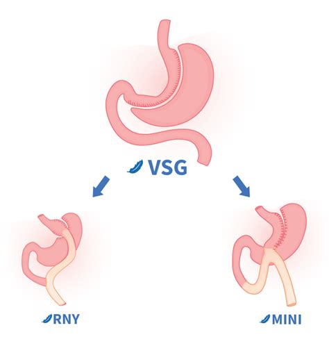 Revision Bariatric Surgery Go Light Bariatrics