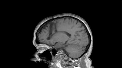 The Effects of Brain Lobotomy: a Summary | 2024