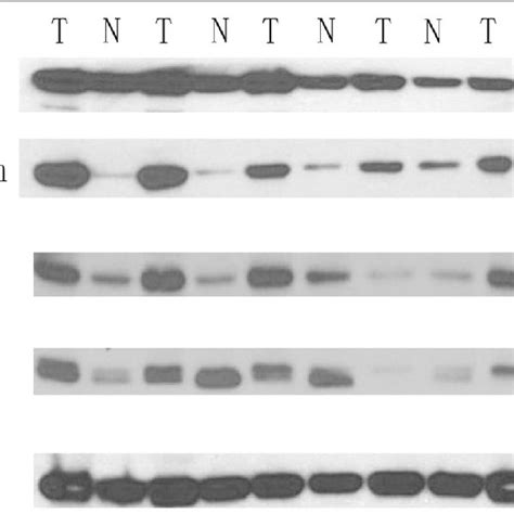 Gli1 P Akt And Emt Pathway Markers Are Upregulated In Nsclc Tissue