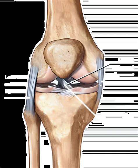 MCL injuries - Dr Seeto