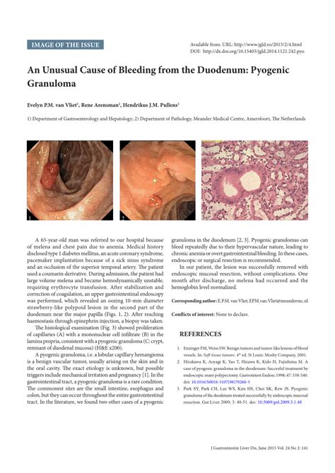 PDF An Unusual Cause Of Bleeding From The Duodenum Pyogenic Granuloma