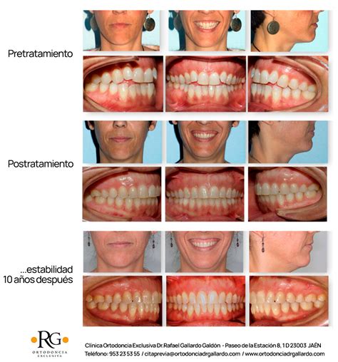 Mordida Abierta Antes Y Despu S Con El Sistema Damon Ortodoncia