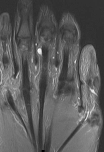 Ganglion Cyst -MRI - Sumer's Radiology Blog